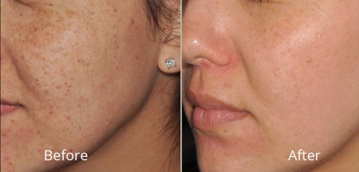 IPL Photofacial treatment for pigmentation