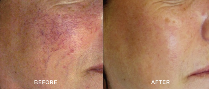 IPL for rosacea