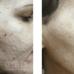 Dermapen Microneedling