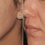 Photofacial