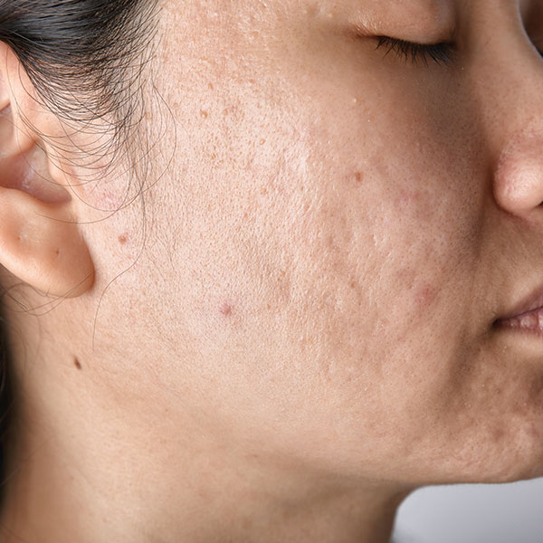 acne-scar