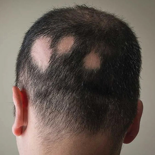 alopecia