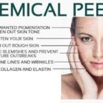 Chemical Peel