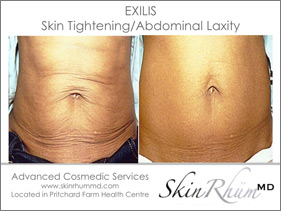 Exilis Fat Removal – SkinRhümMD