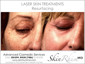 laser-resurfacing