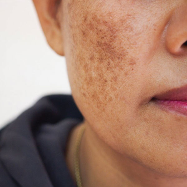 melasma