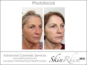 photofacial