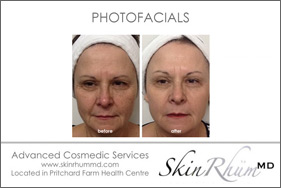 photofacial