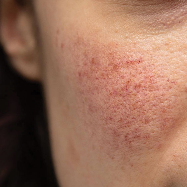 rosacea