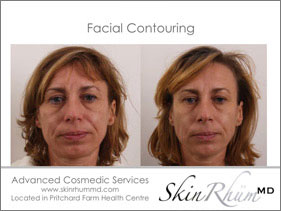 Facial Contouring