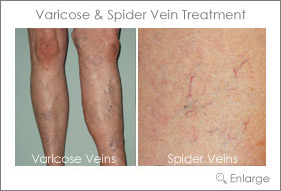 Vein Treatments