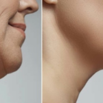 Clear Lift™ Skin Tightening x3 (Lower Jawline, Eyes, & Neck)